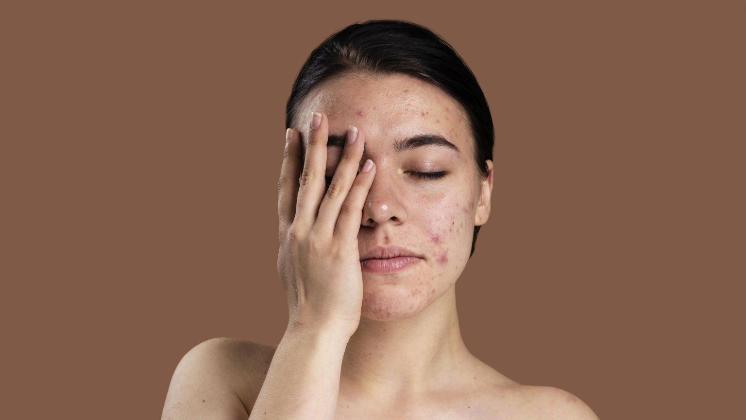 Preventing Acne: A Doctor’s Guide to Clearer Skin By Dr. Almas Fatma